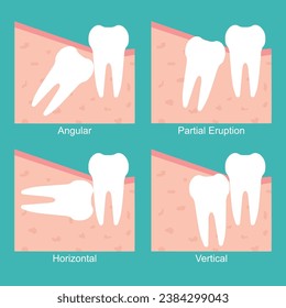 Dental Classification of impacted wisdom teeth vector. Dental Classification of impacted wisdom tooth vector