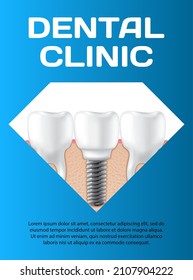 Dental clinic poster vector illustration. Advertising of hospital for teeth treatment. Medical services for installation of dental implant. Human gum with healthy teeth and denture on dentistry banner
