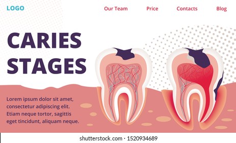 Dental Clinic, Stomatology Innovative Technology for Caries Treatment Medical Startup Trendy Flat Vector Vector Web Banner, Landing Page Template. Teeth with Damaged Enamel Cross Section Illustration