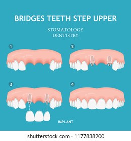 Dental concept. Dentistry and stomatology poster. Implant.
