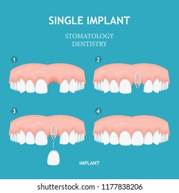 Dental concept. Dentistry and stomatology poster. Implant.