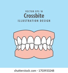 Dental crossbite teeth illustration vector design on blue background. Dental care concept.