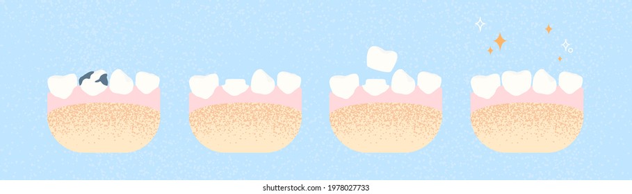 Dental crown. Illustration of a dental crown procedure. Dentistry and orthopedics concept.