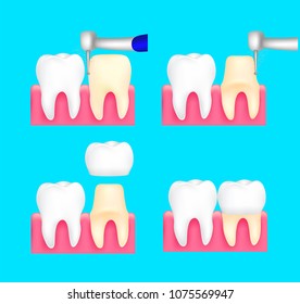 Dental crown installation process. Dental care concept. Illustration isolated on blue background.