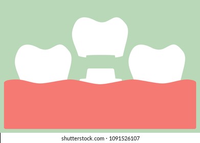 dental crown, installation process and change of teeth - tooth cartoon vector flat style cute character for design