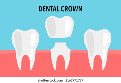 Dental crown installation process in flat design.