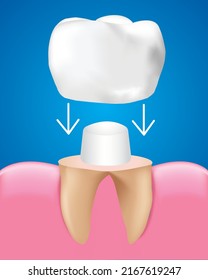 Dental Crown Restoration, Dental care concept, Realistic design illustration Vector .