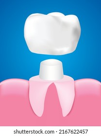 Dental Crown Restoration, Dental care concept, Realistic design illustration Vector.