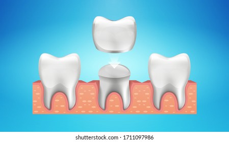 Dental Crown Restoration in realistic style. Medically accurate. Vector illustration 