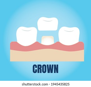 Dental crown, tooth treatment icon. Tooth prosthesis sign. Medicine symbol for info graphics, websites and print media. Vector flat icon.