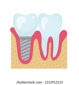 Dental crowns and implantation prosthodontics elements and tools. Vector flat illustration. Teeth element for design concept, poster, banner.