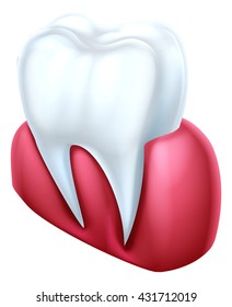 A dental cutaway medical illustration of a tooth and gum