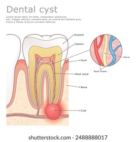 Dental cyst medical vector illustration labeled. 