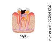 Dental disease flat poster with pulpitis anatomy vector illustration