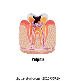 Dental Disease Flat Poster With Pulpitis Anatomy Vector Illustration