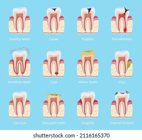 Dental disease with names collection vector flat illustration. Dentistry oral problem educational infographic set with caries, inflammation, flux, enamel erosion, pulpitis, calculus, gingivitis