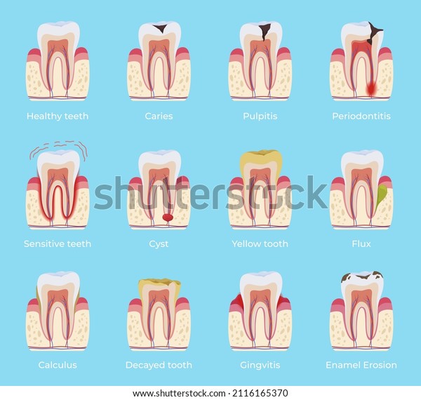 Dental disease with names collection vector\
flat illustration. Dentistry oral problem educational infographic\
set with caries, inflammation, flux, enamel erosion, pulpitis,\
calculus, gingivitis