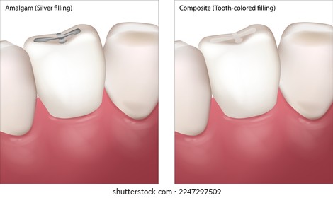 Dental Filling Procedure. Amalgam Silver filling and Composite Tooth colored filling.