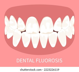 Dental Fluorosis teeth discolored pitted grooved Turner's hypoplasia