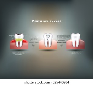 Dental health care tips. Diet without sugars, brushing, fluoride treatment etc. And tooth with caries failure to comply with hygiene 