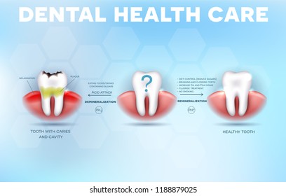 Dental health care tips, how to prevent tooth decay formation and acid attack detailed diagram