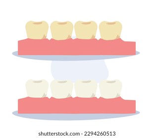 Dental health concept. tooth whitening and tooth with yellow plaque before, after . Flat cartoon Vector illustration