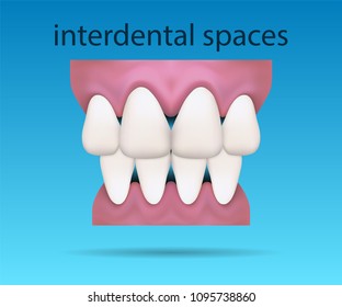 Dental illustration showing interdental spaces between teeth on the blue background. Aesthetic dentistry. Vector 10 EPS.