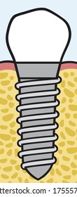 dental implant