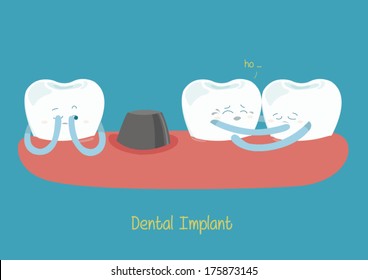 dental implant 