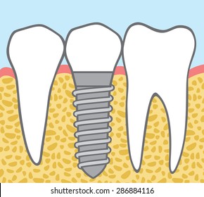 dental implant