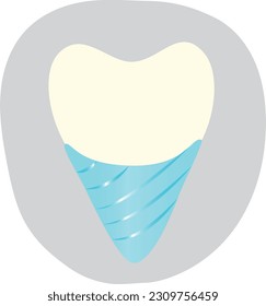 Dental implant. Artificial tooth. High quality vector illustration.