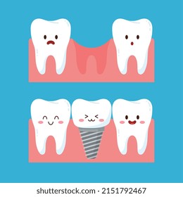 Dental implant before and after, cute teeth character and gum, flat vector illustration isolated on white background. Cartoon teeth with happy faces. Tooth replacement concept.