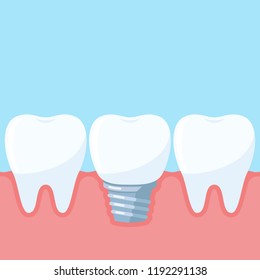 Dental implant, between the normal teeth. Dental clinic services. Vector illustration in flat style