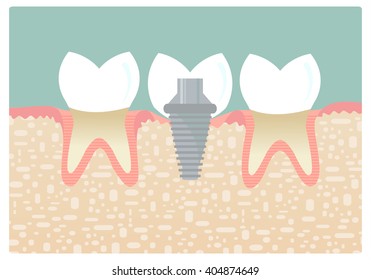 Dental implant  between two healthy teeth . Vector illustration .  All objects are conveniently grouped  and are easily editable.