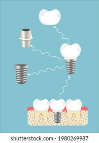 Dental implant components in dentistry