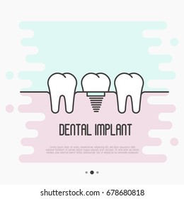 Dental implant concept: two healthy teeth and implant tooth between. Thin line vector illustration.