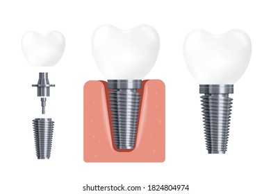 Dental implant construction and implementation. Dentist equipment for work to change crowns, flat cartoon vector illustration isolated white background