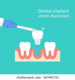 Dental implant. Dentist holding in hand tweezers sets of dentures. Medical equipment. Tooth treatment. Vector illustration flat design. Isolated on background. Stomatology concept.