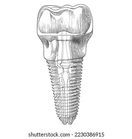 Dental implant dentistry sketch hand drawn sketch, engraving style vector illustration