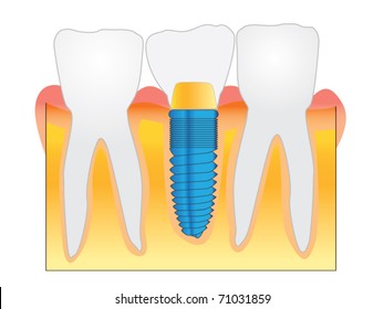 Dental Implant detailed view. Vector. Illustration.