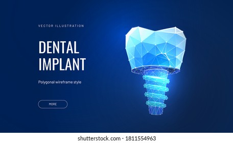 Dental implant, digital technologies in dentistry. Vector illustration of a denture in a polygonal futuristic style. Molar surgery illustrated by a geometric luminous shape