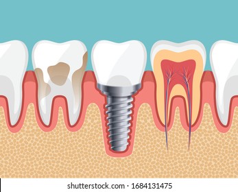 Dental Implant, Dirty tooth, Healthy tooth, Tooth inside, Human teeth, Vector illustration. 