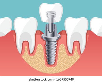 Dental Implant elements and Healthy tooth, Human teeth, Vector illustration. 