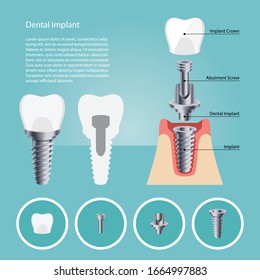 Dental Implant elements and Human teeth, Vector illustration. tooth