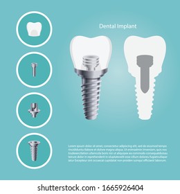 Dental Implant elements and Human teeth, Vector illustration. tooth