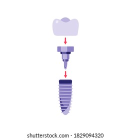 Dental implant flat cartoon illustration. Orthodontic banner design. Prostetic tooth background. Stomatology concept.