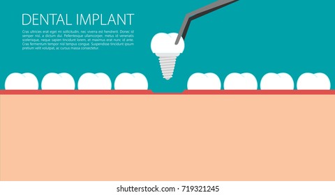 Dental implant flat vector 