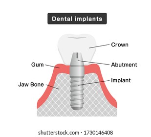 Dental implant flat vector illustration