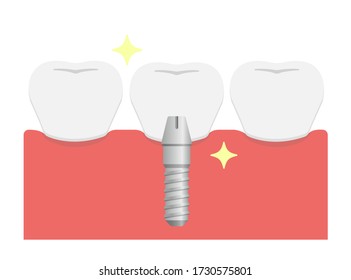 Dental implant flat vector illustration / Set artificial teeth (crown)