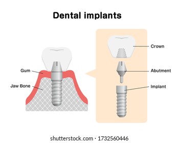 Tooth Implant Realistic Implant Structure Pictorial Stock Vector ...